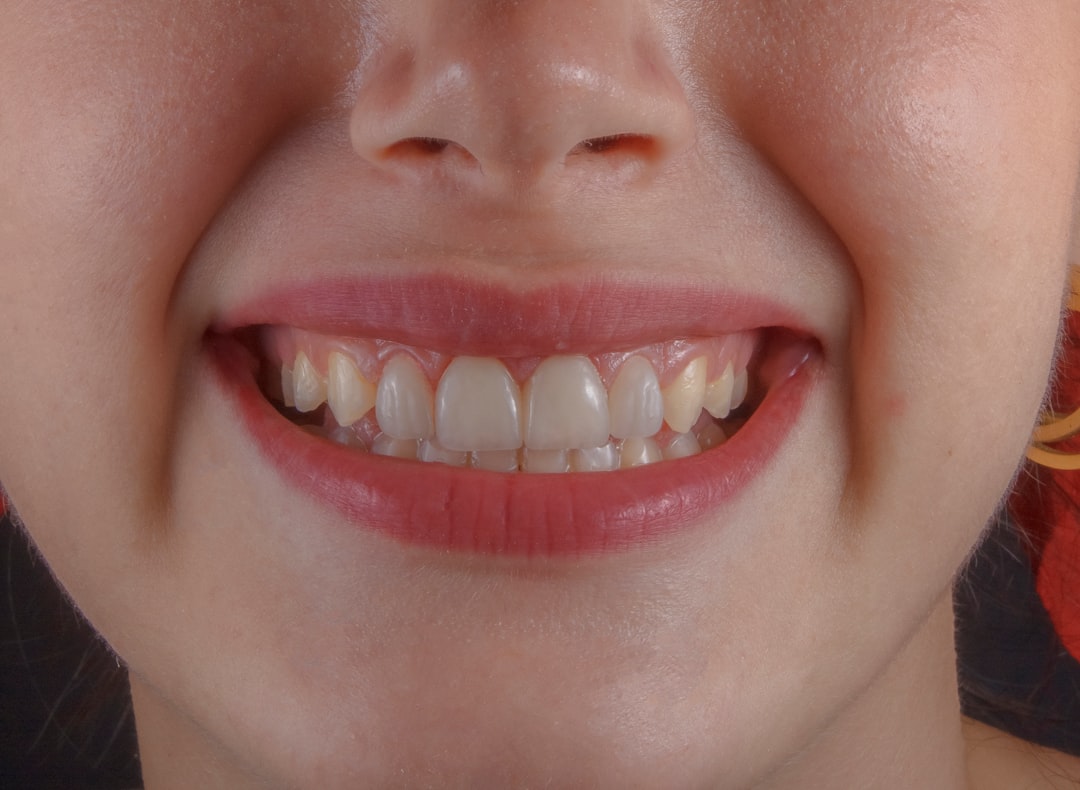 invisible line teeth