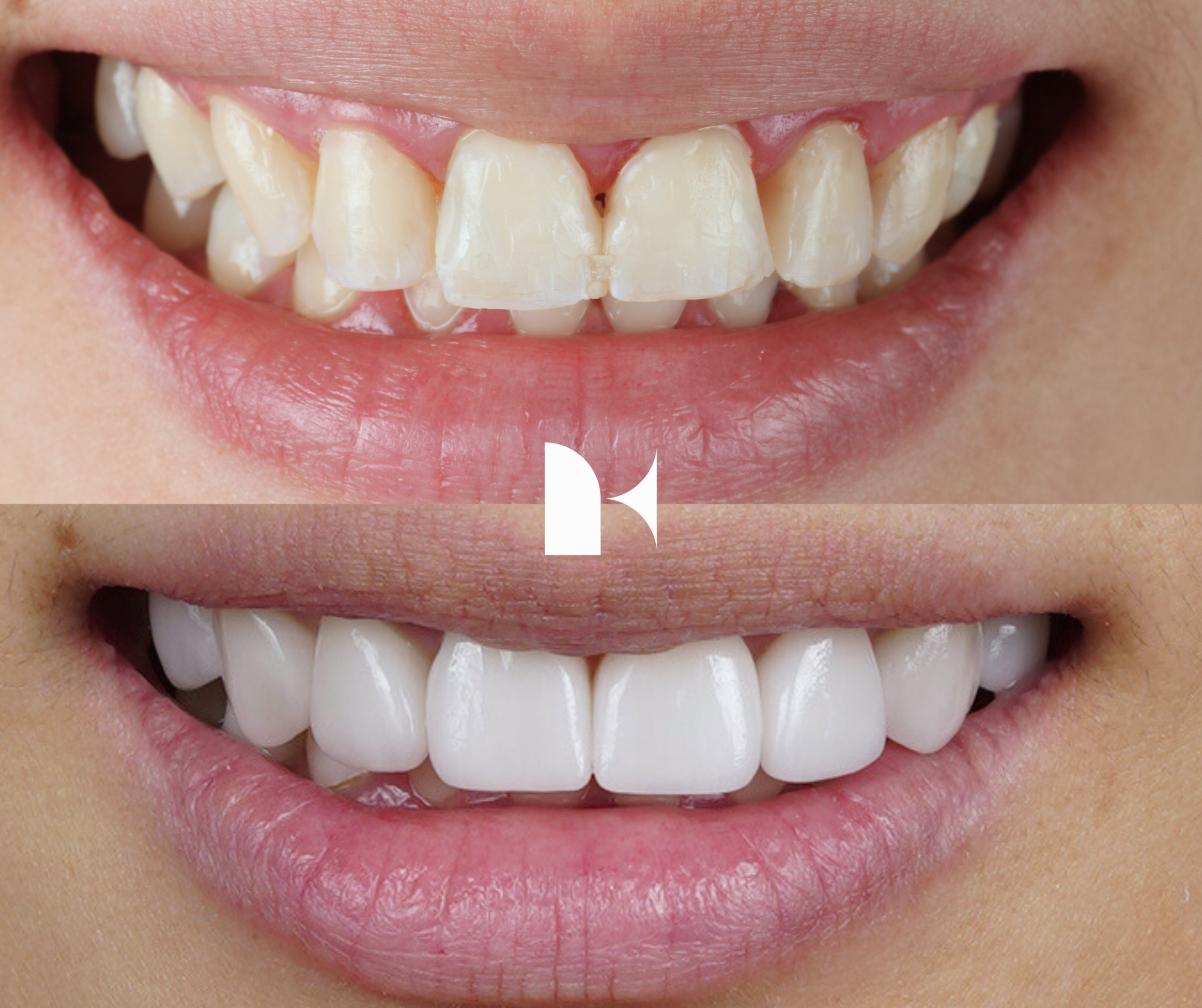 porcelain-veneers-before-after-sydney