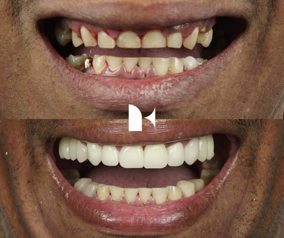 porcelain-veneers-before-after-sydney
