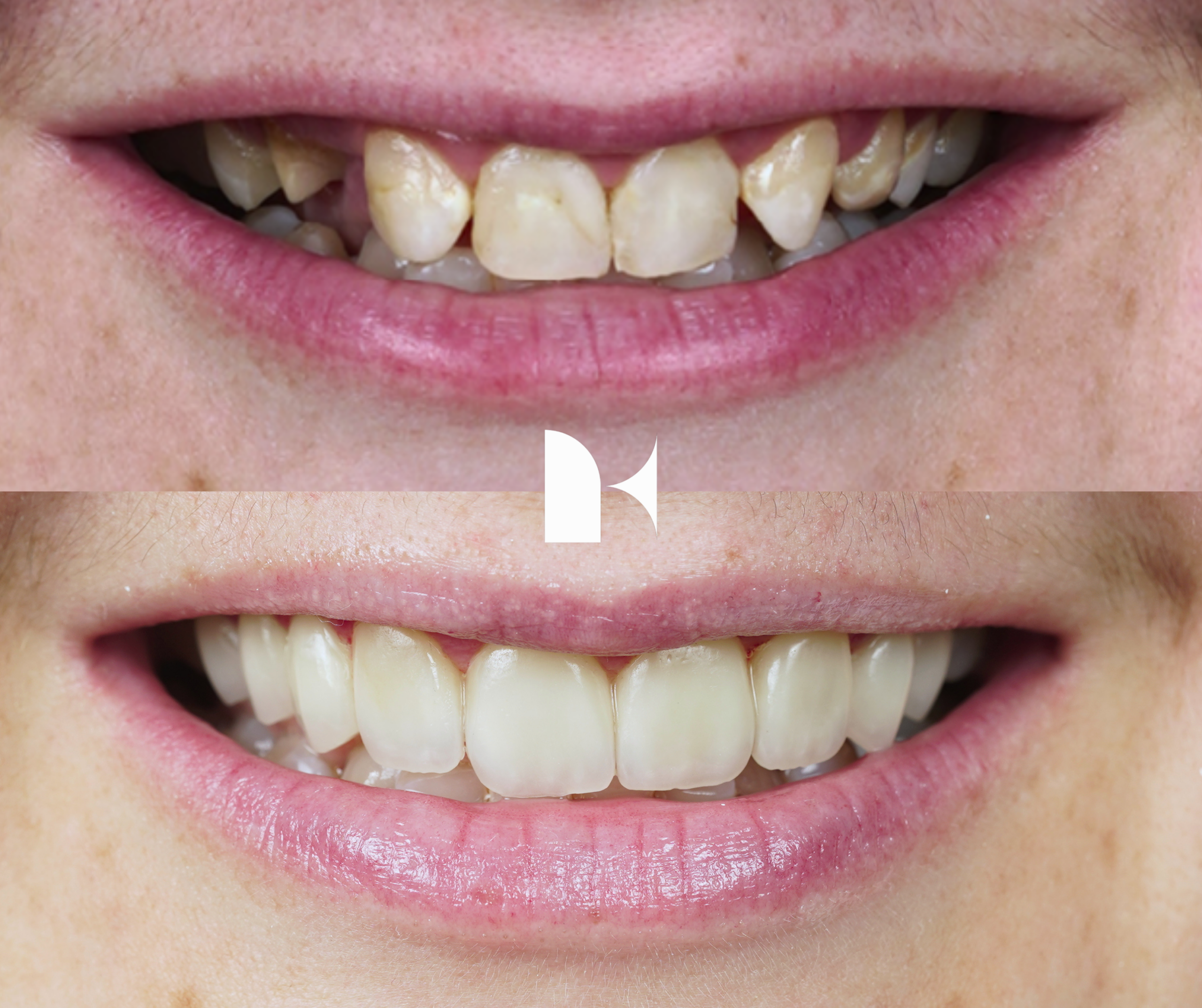 porcelain-veneers-before-after-sydney