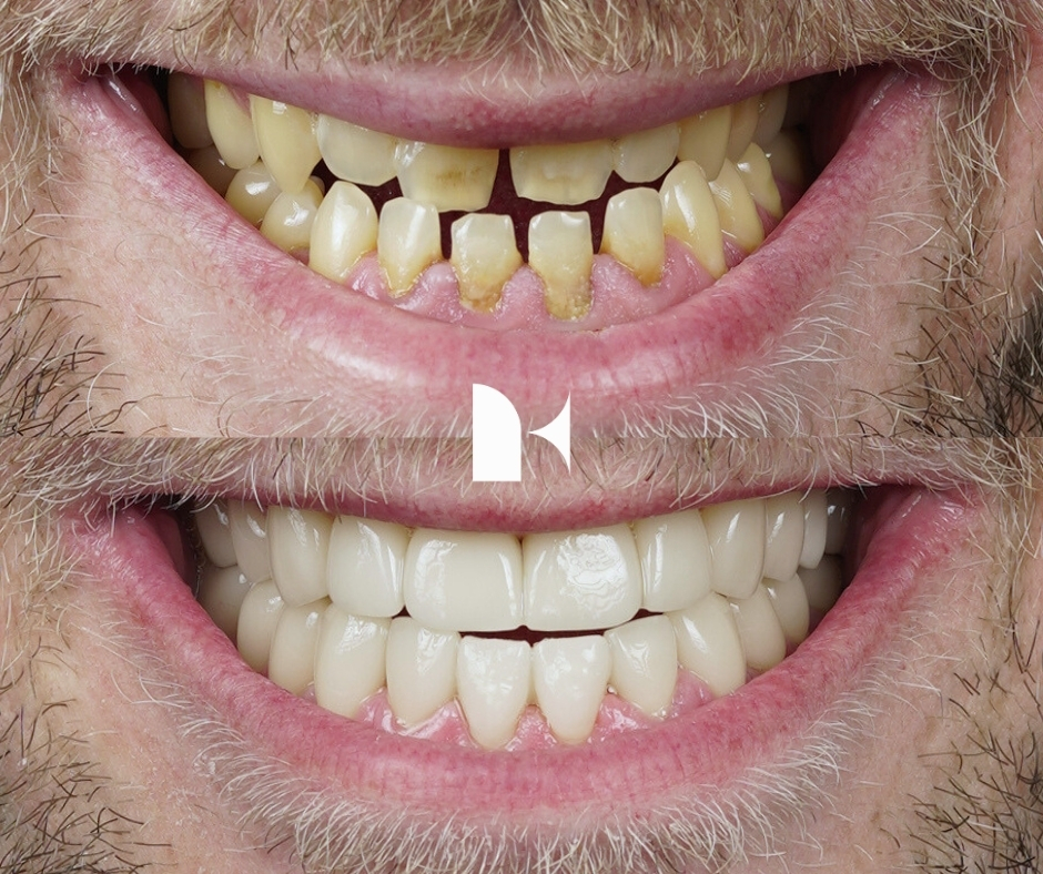 porcelain-veneers-before-after-sydney