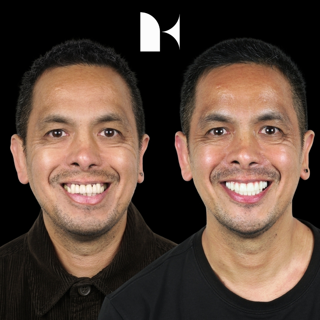 all-on-4-dental-implants-before-after-sydney