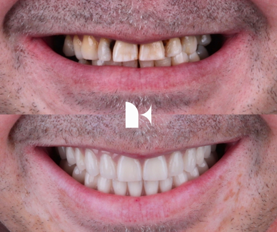 all-on-4-dental-implants-before-after-sydney