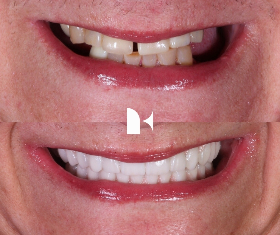 all-on-4-dental-implants-before-after-sydney