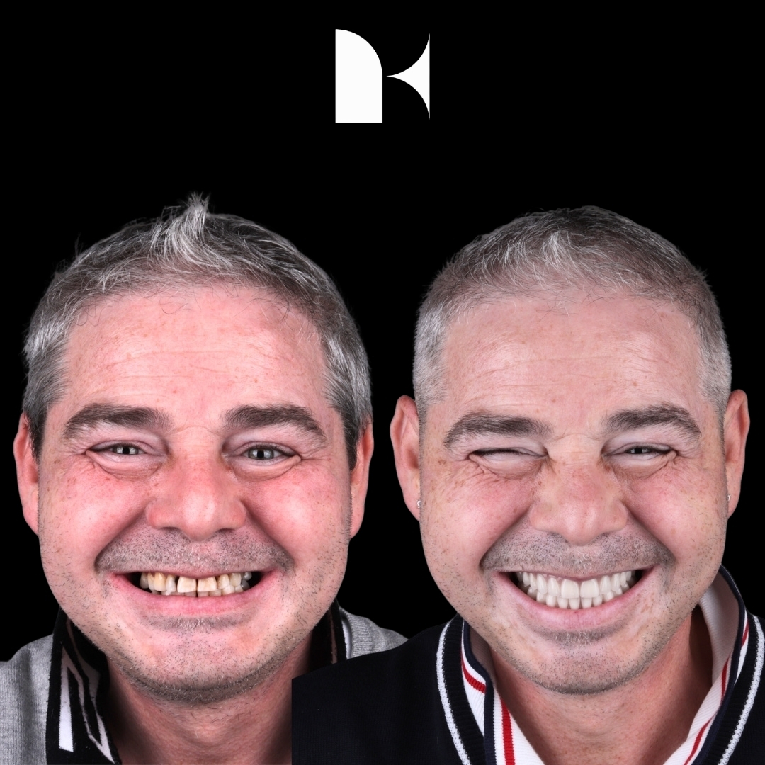 all-on-4-dental-implants-before-after-sydney