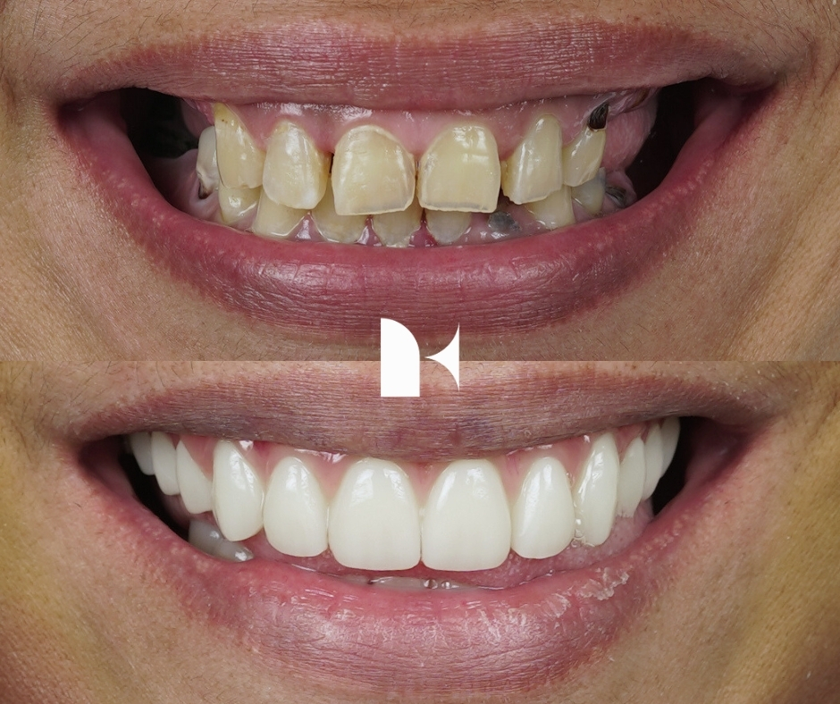 all-on-4-dental-implants-before-after-sydney