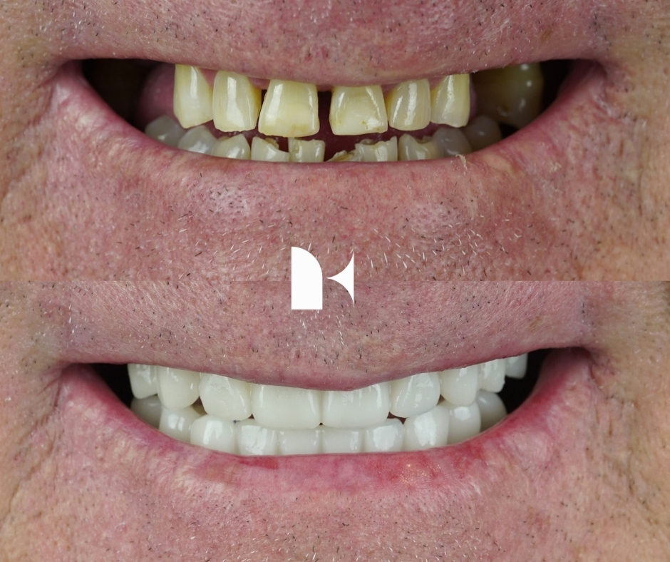 all-on-4-dental-implants-before-after-sydney