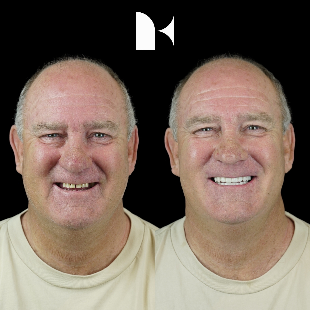 all-on-4-dental-implants-before-after-sydney