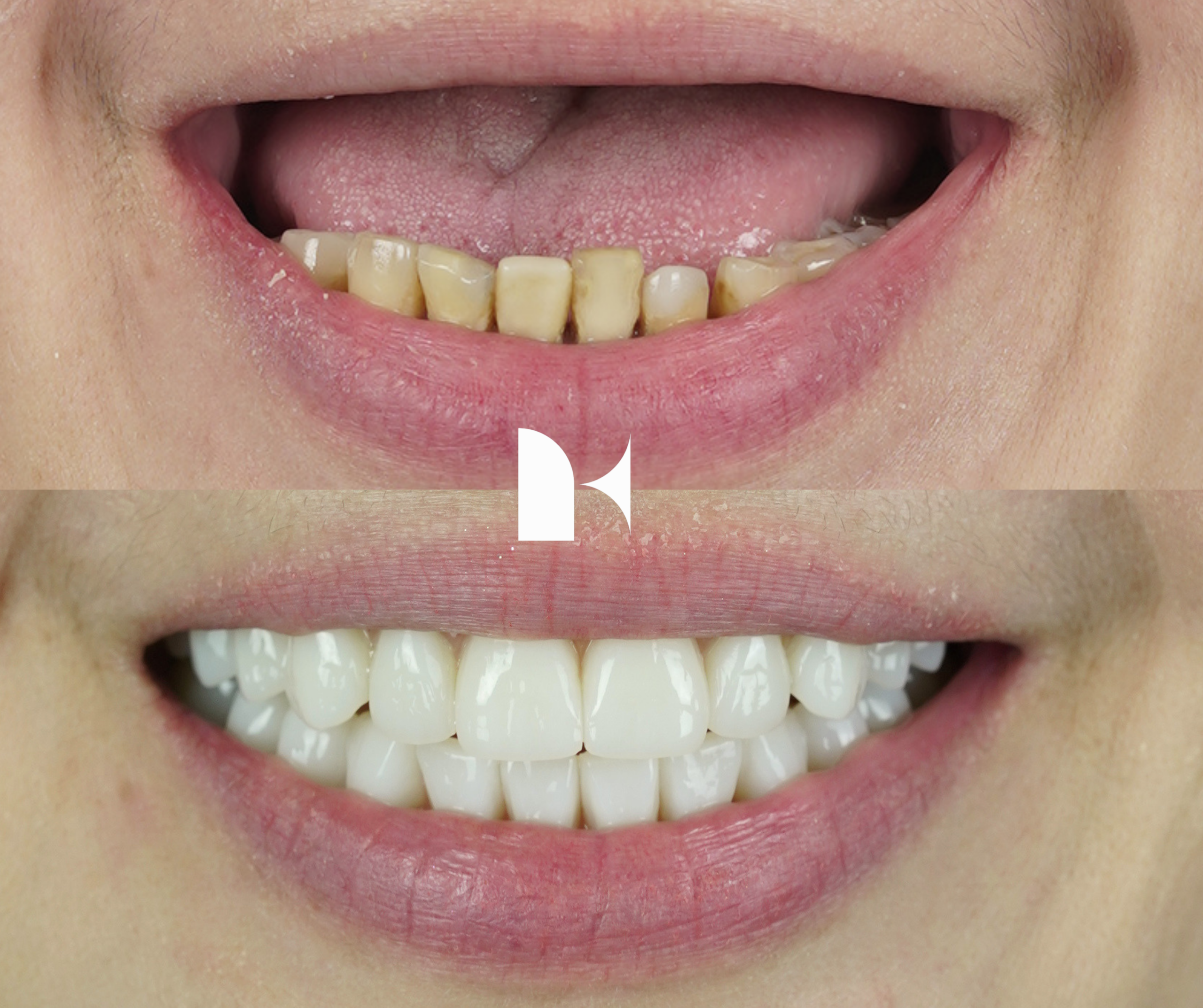 all-on-4-dental-implants-before-after-sydney