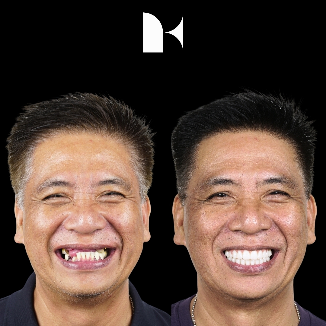 all-on-4-dental-implants-before-after-sydney