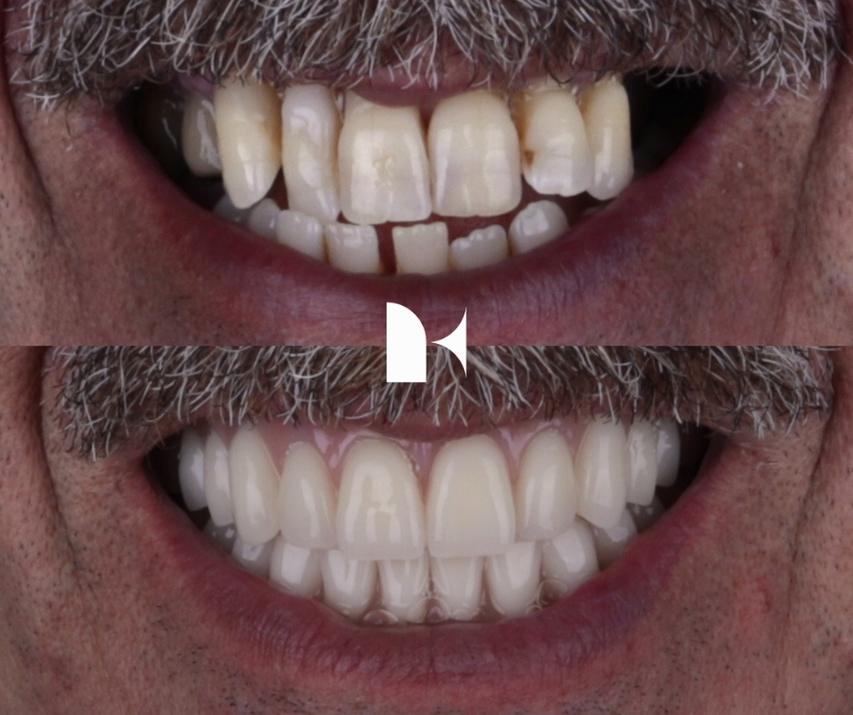all-on-4-dental-implants-before-after-sydney