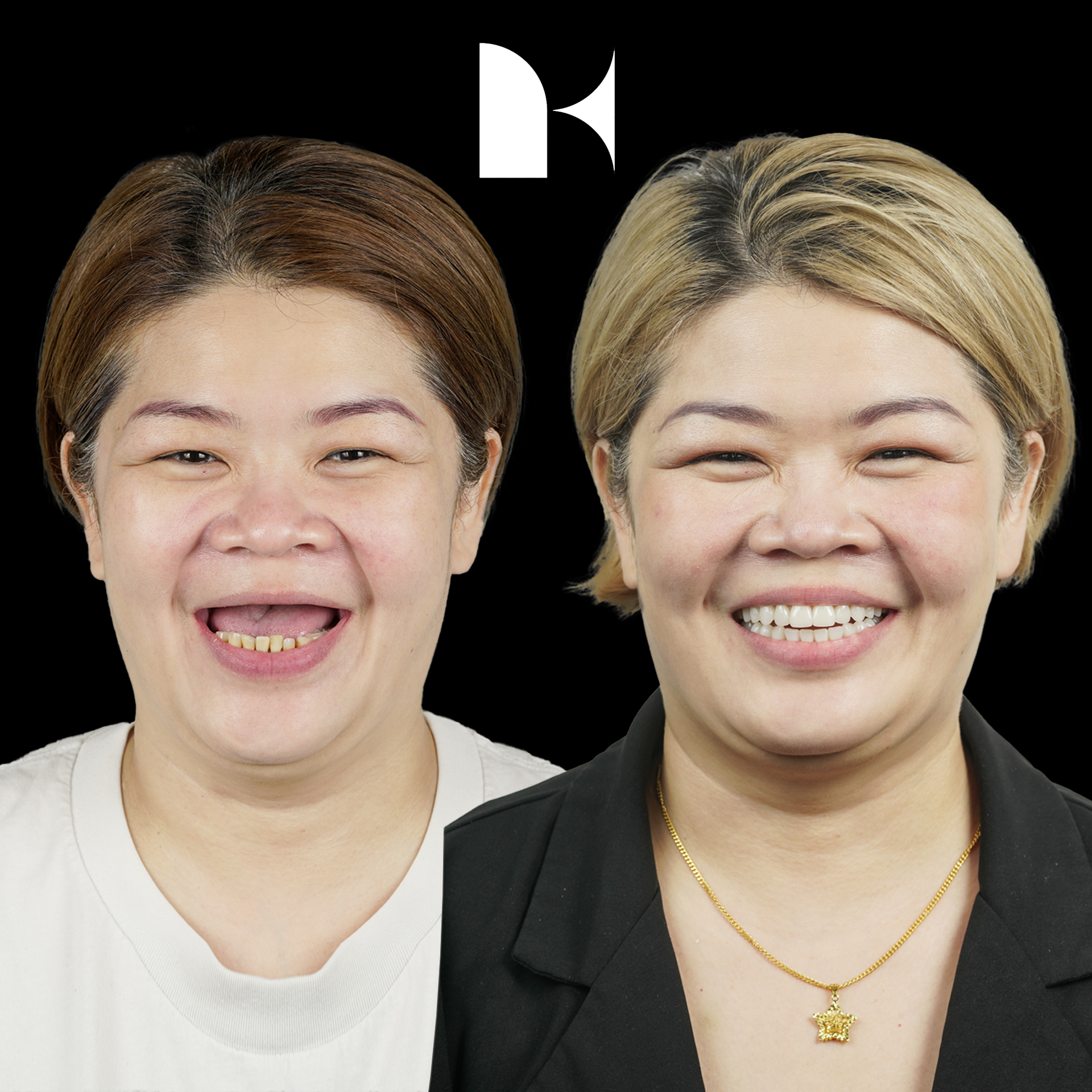 all-on-4-dental-implants-before-after-sydney