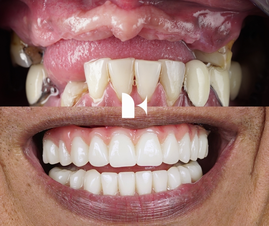 all-on-4-dental-implants-before-after-sydney
