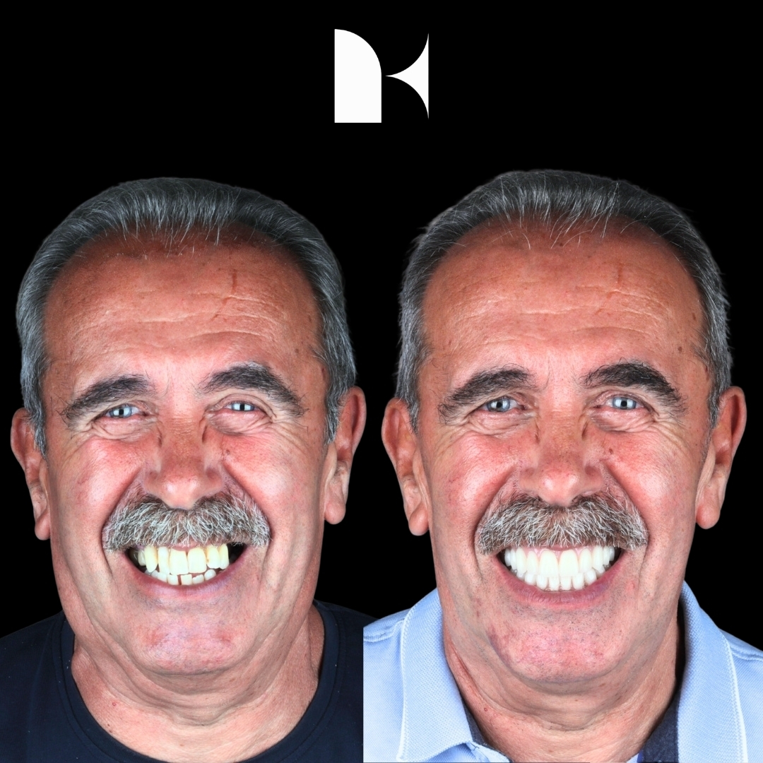 all-on-4-dental-implants-before-after-sydney