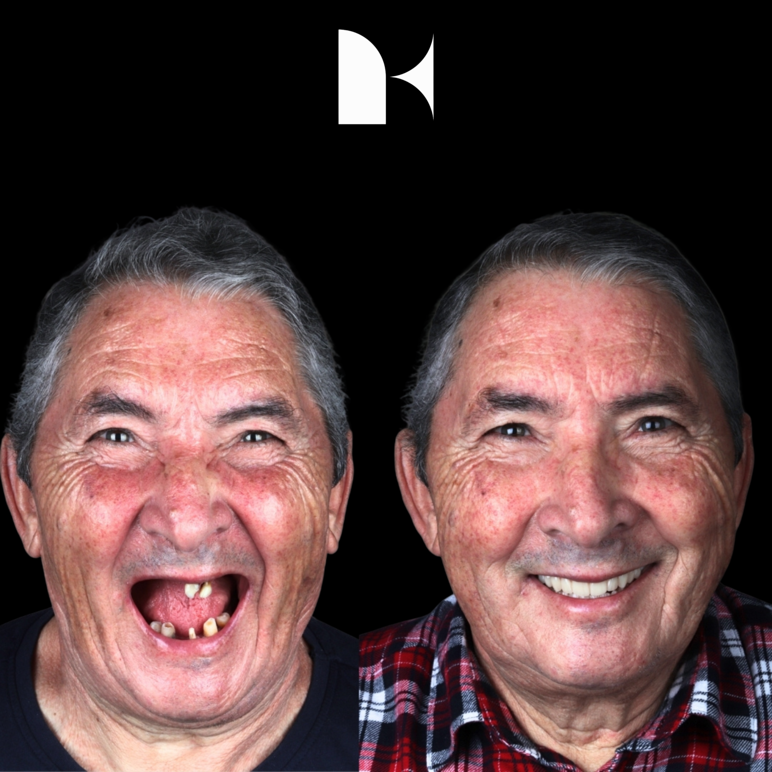 all-on-4-dental-implants-before-after-sydney