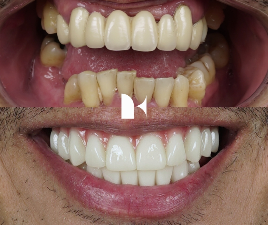 all-on-4-dental-implants-before-after-sydney
