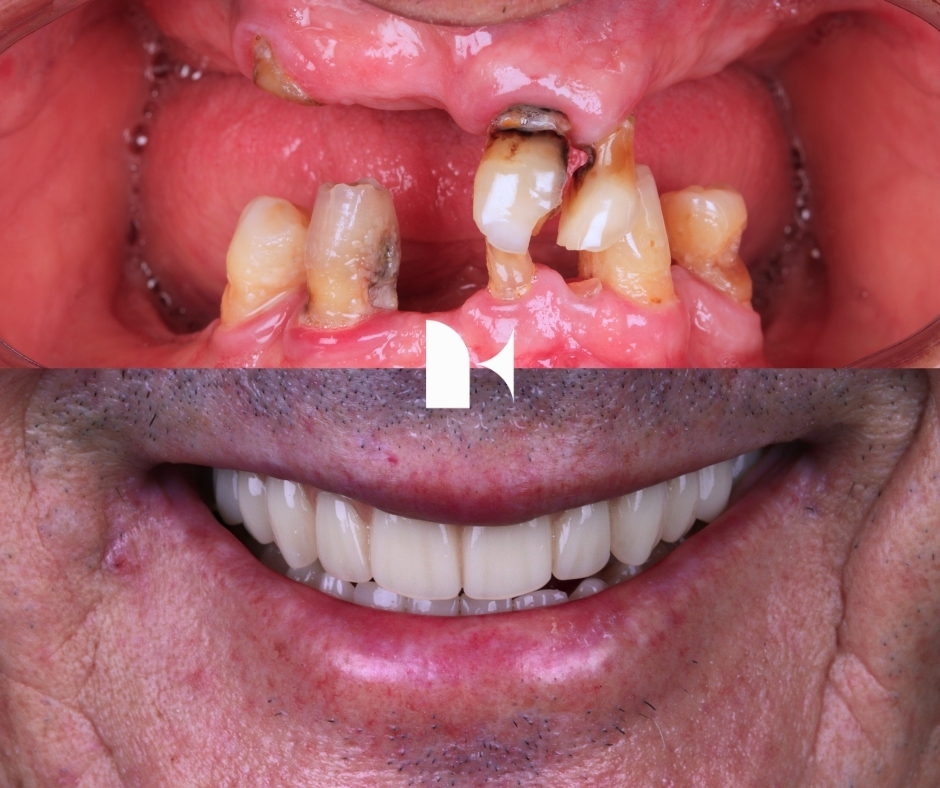 all-on-4-dental-implants-before-after-sydney