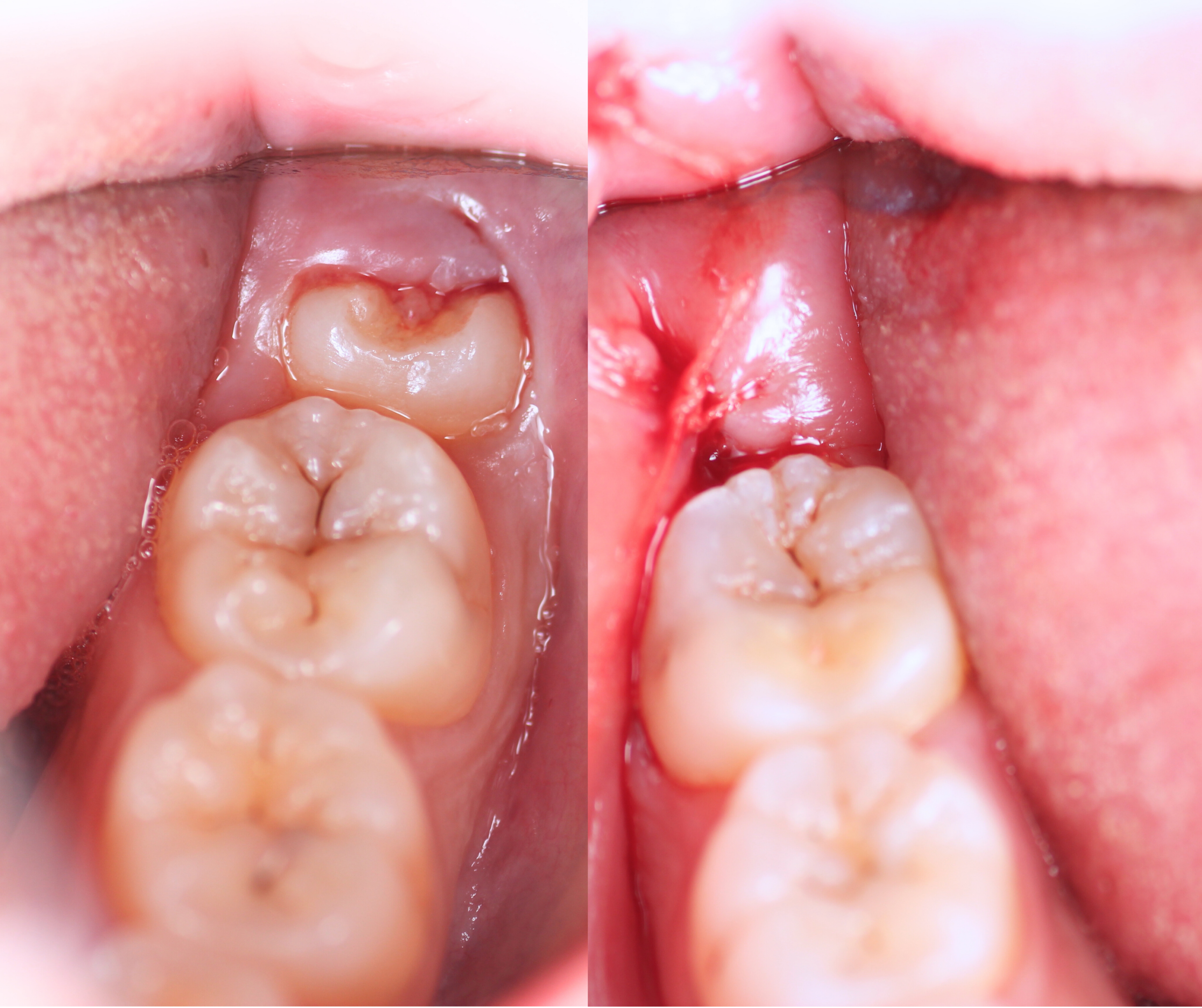 emergency-dental-extraction-sydney
