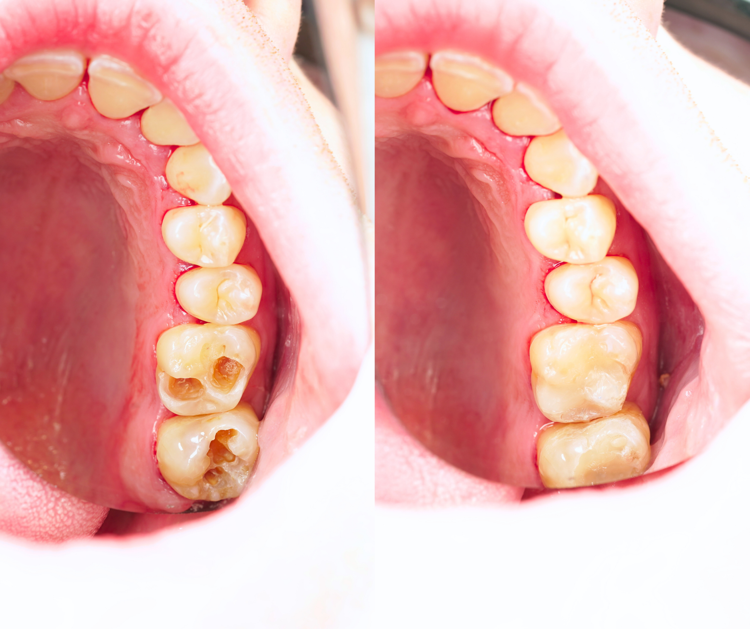 emergency-dental-filling-sydney