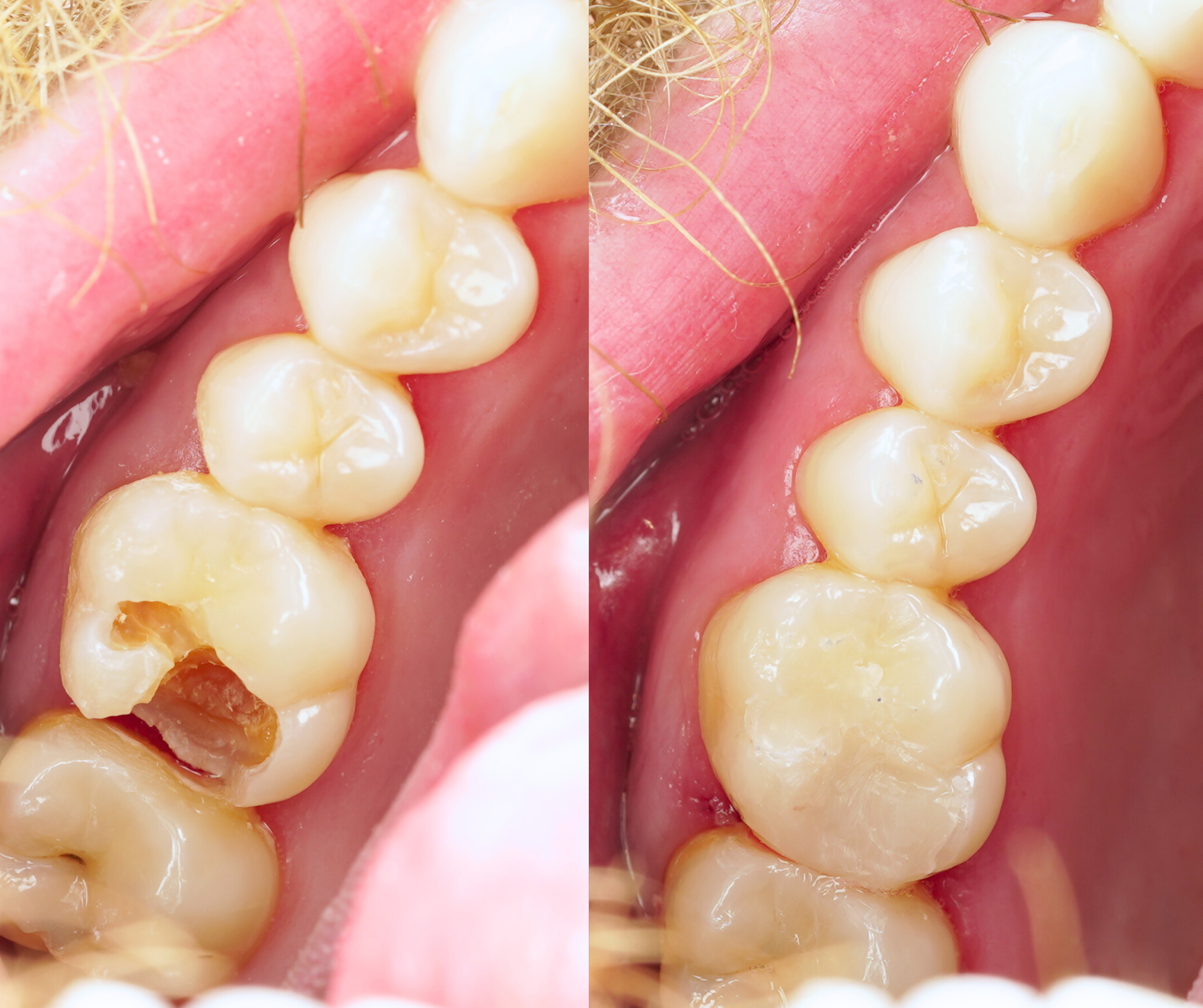 emergency-dental-fillings-sydney