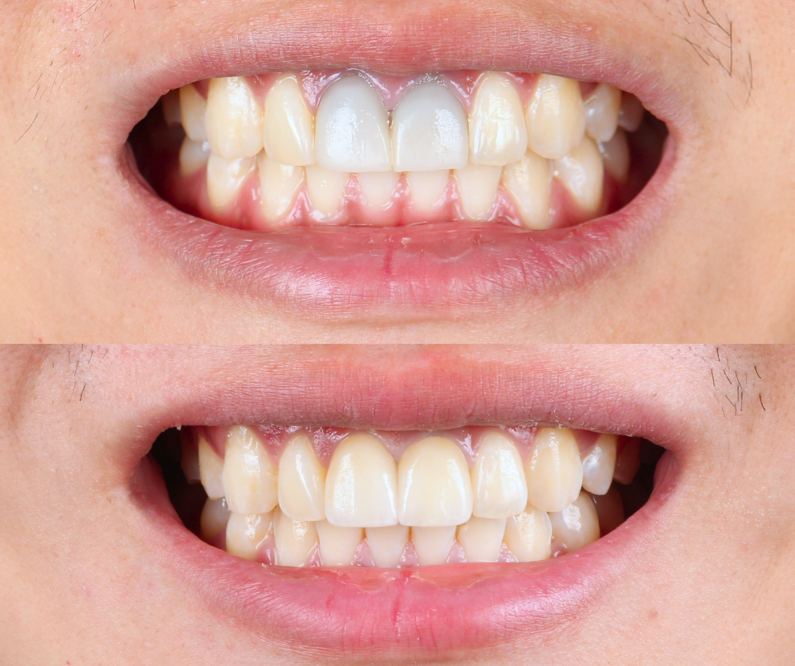 emergency-dental-root-canal-treatment-sydney