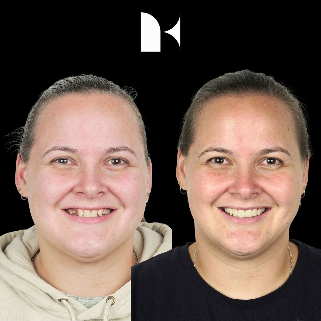 porcelain-veneers-before-after-sydney