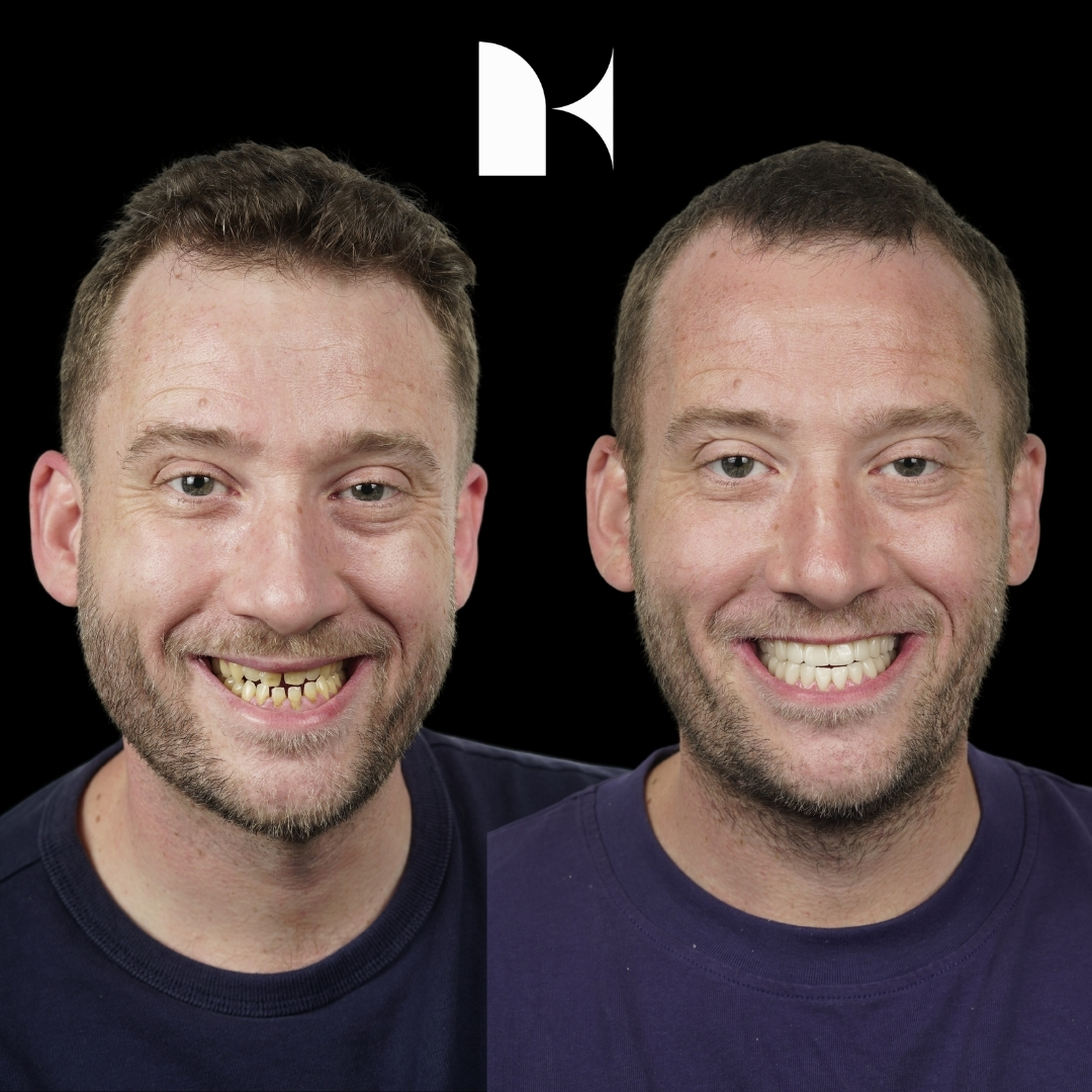 porcelain-veneers-before-after-sydney
