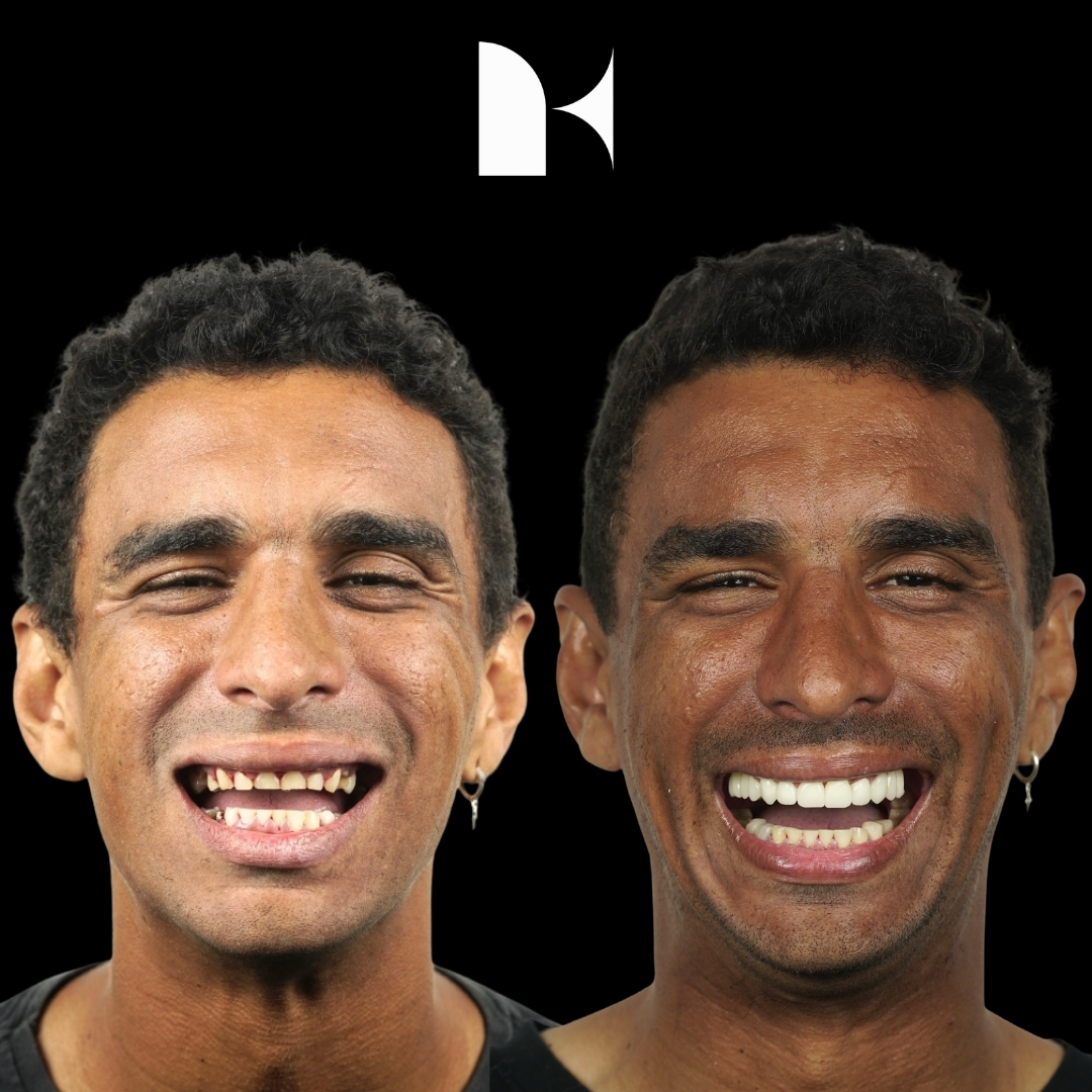 porcelain-veneers-before-after-sydney