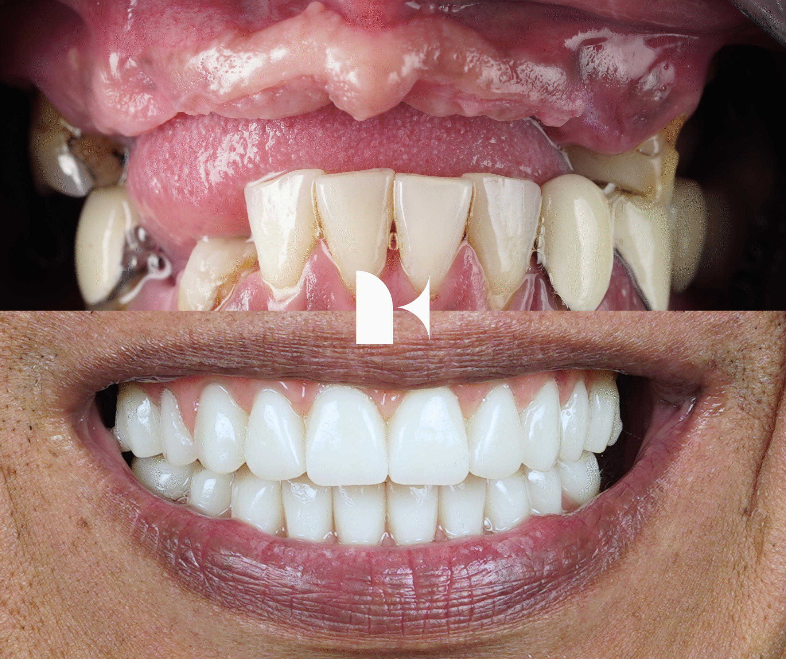 Treatment: All On 4 Dental ImplantsResult: 2 weeks post-procedure