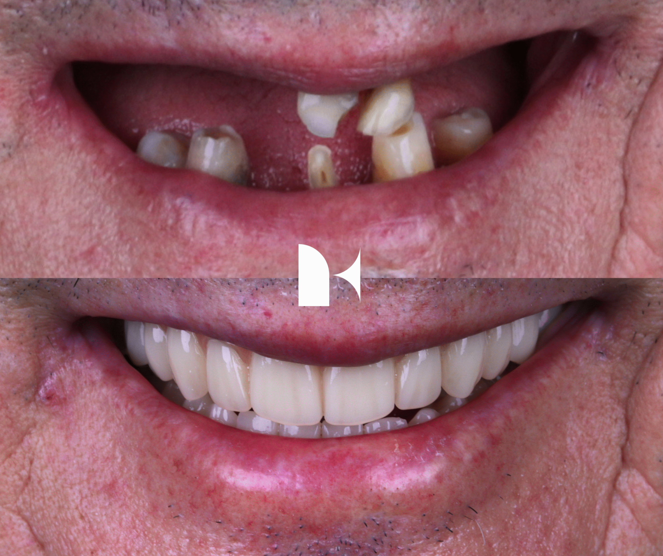 Treatment: All On 4 Dental Implants Result: 3 months post-procedure