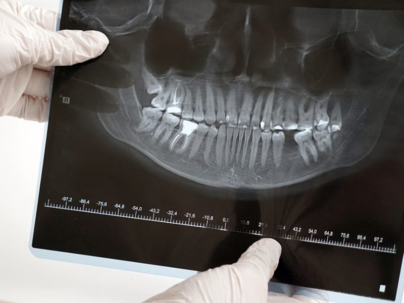 Dental-CT-Scans