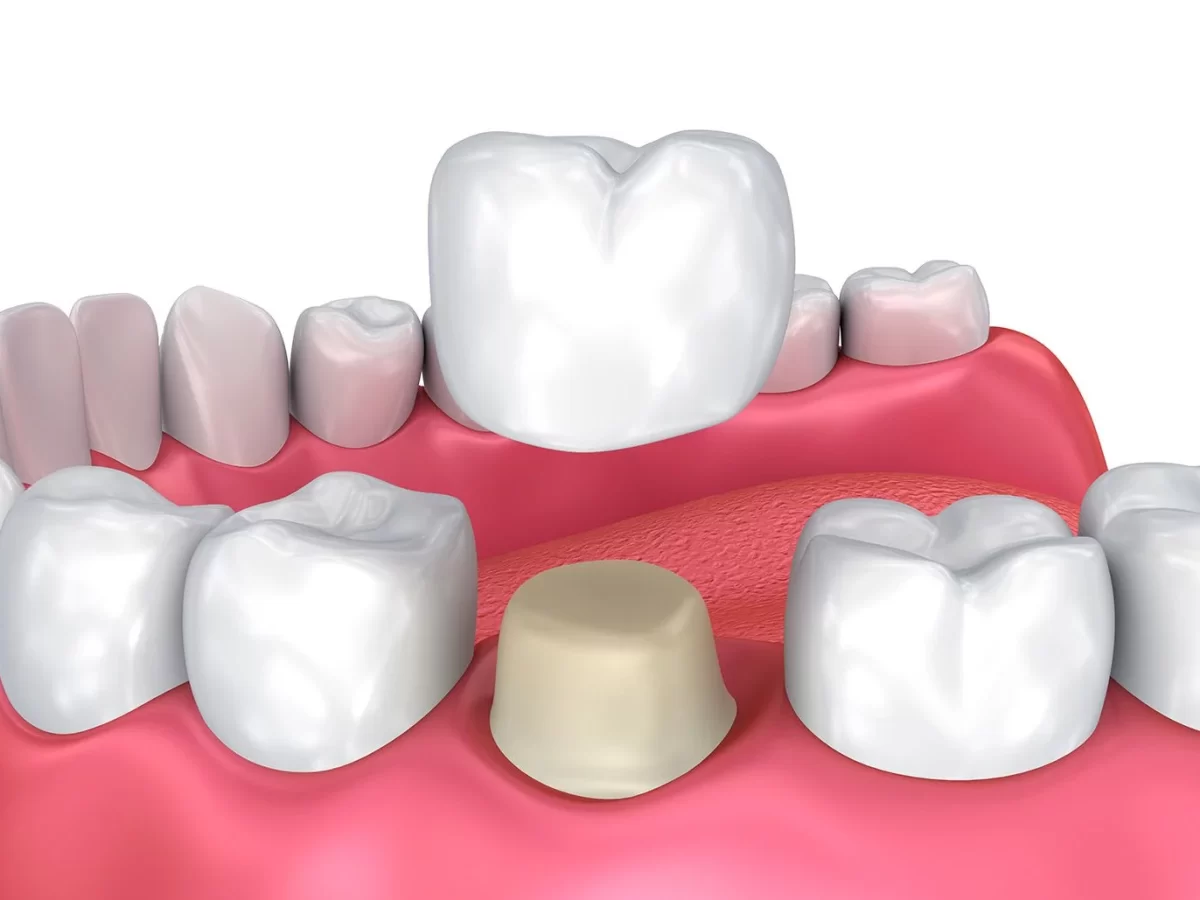 Dental-Crown-Protection-for-Weak-Tooth