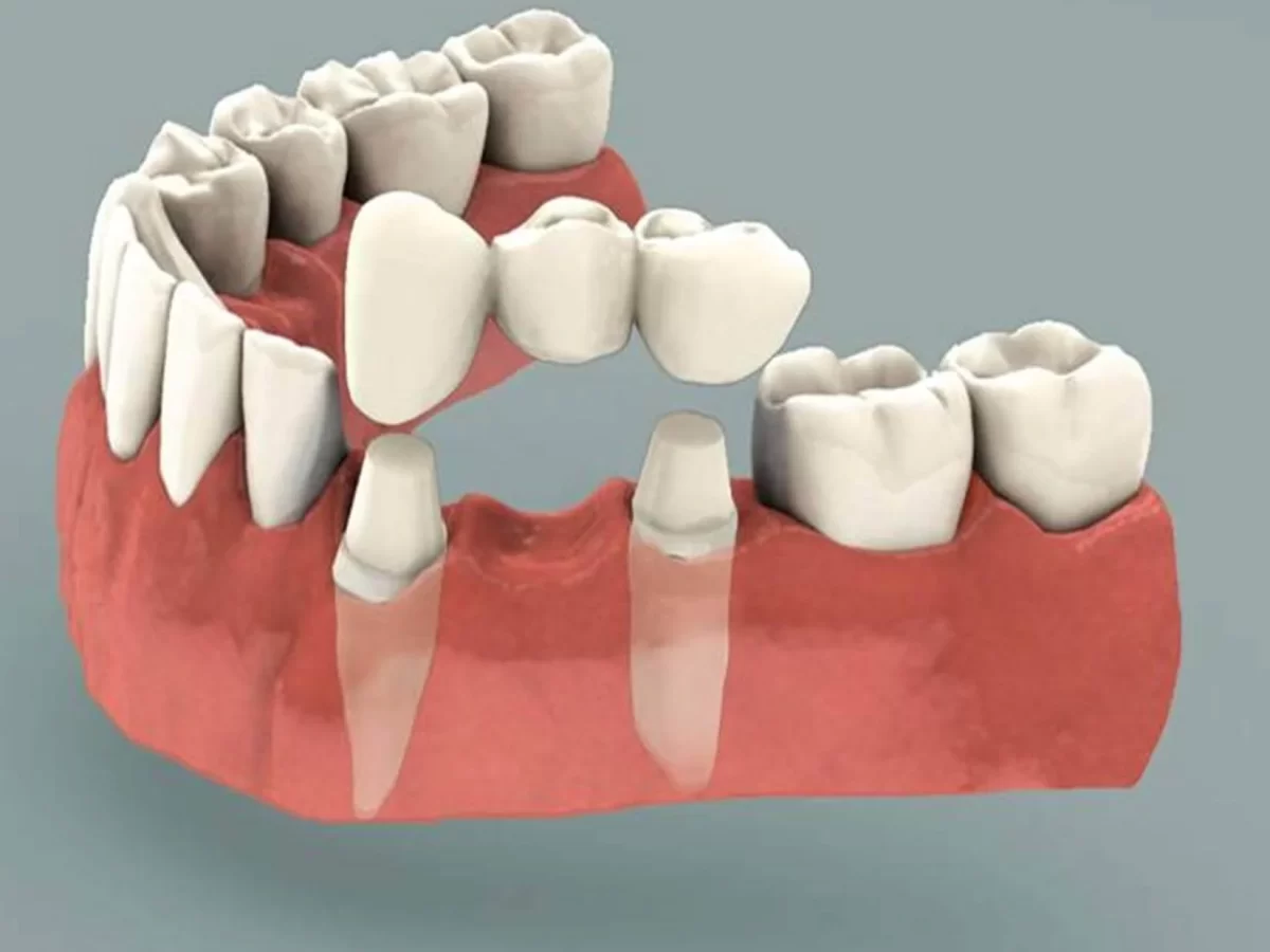 dental-bridges-1-1