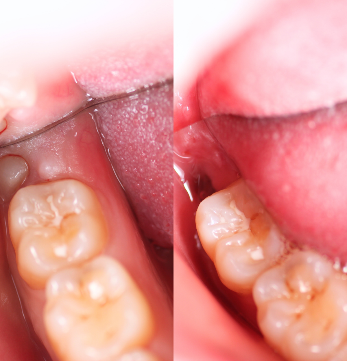 emergency-dental-pain-treatment-sydney