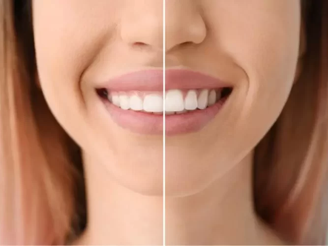 how-to-fix-a-gummy-smile-without-surgery