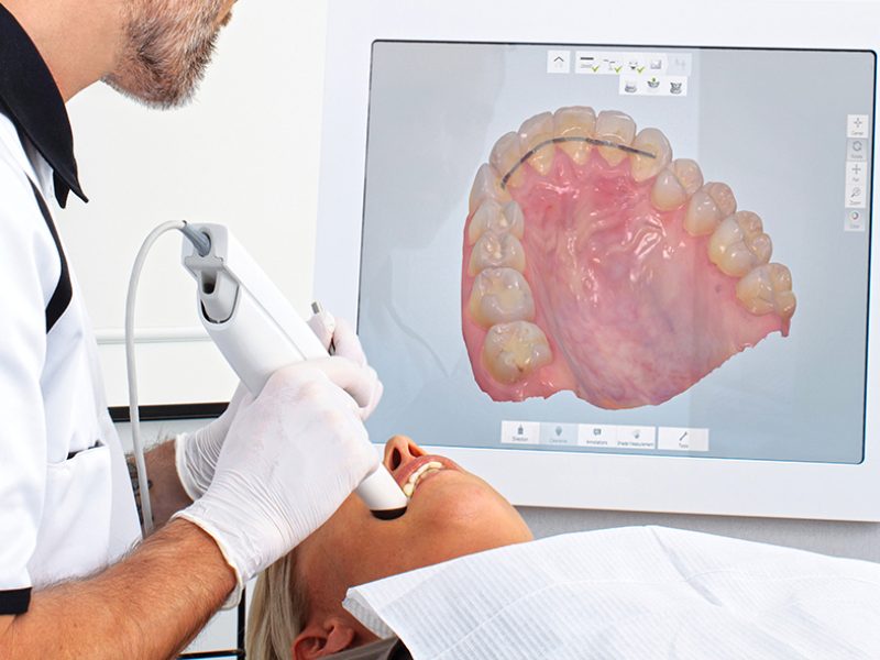 intra oral dental scanner