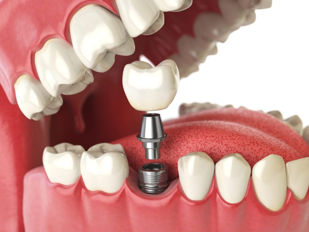 types-of-dental-implants-which-one-is-best-for-you