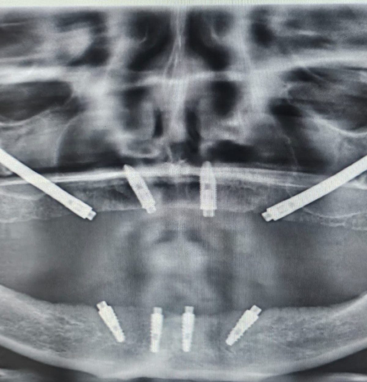 zygomatic-dental-implants-sydney